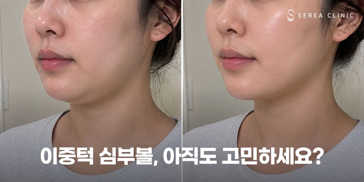 🔥 심부볼·이중턱 전후, 직접 확인하세요